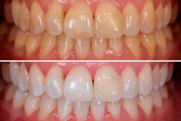 Branqueamento dentário profissional
