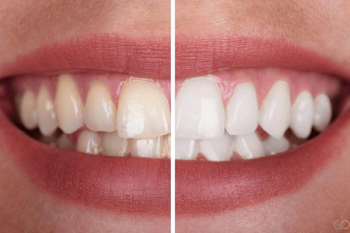 Estética Dentária