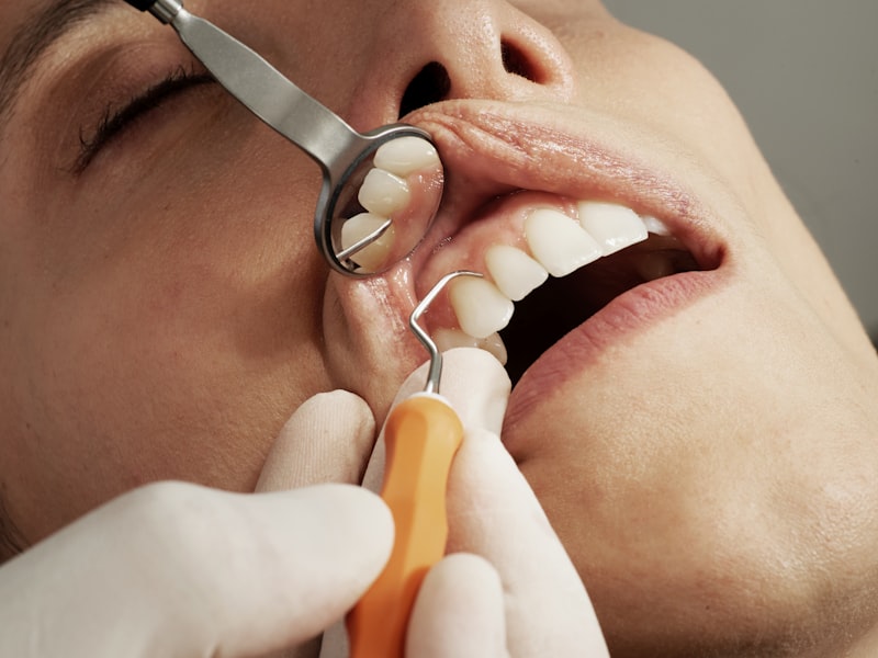 Implantes Dentários